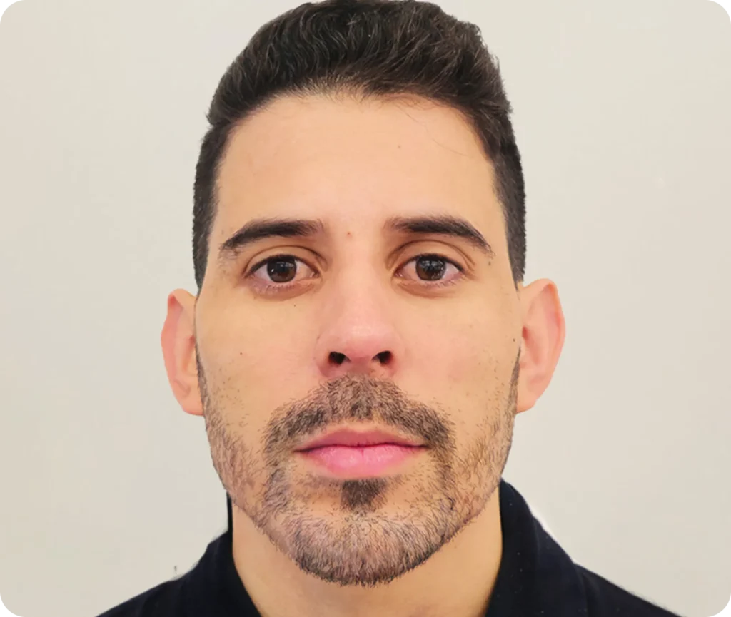 Armonización facial tratamiento 2