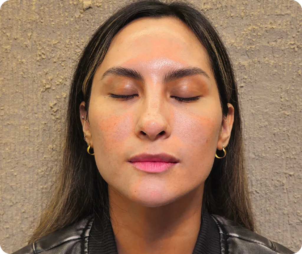 Armonización facial tratamiento